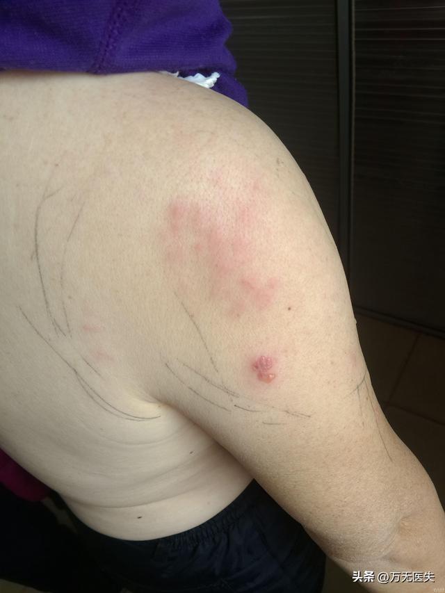 奇才榜眼郎被迫接受脚部手术，这会对他下赛季的表现造成影响吗？